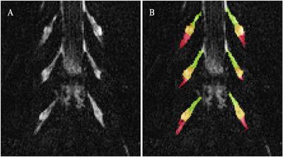 Assessing Lumbar Plexus and Sciatic Nerve Damage in Relapsing-Remitting Multiple Sclerosis Using Magnetisation Transfer Ratio